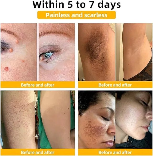 Zidella Skin Lighting Blemish Cream 50g (Pack of 2) - Namma Angadi